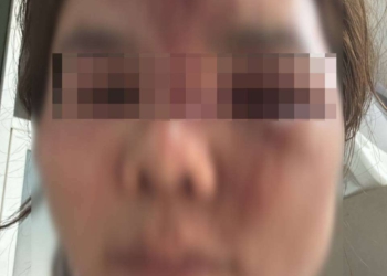 ระยอง โหดสาดเคมีทุบหมอนวดปางตาย